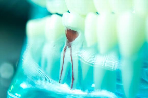 tooth with inflamed roots in jaw